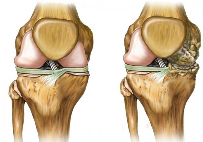Verformung Arthrose